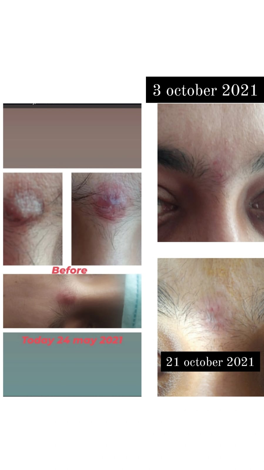 Before After Skin Treatment